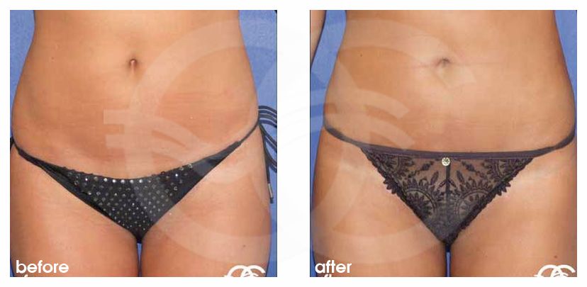 Fettabsaugung 01 LIPOSUKTION BAUCHBEREICH UND UNTERER BAUCH before after forntal