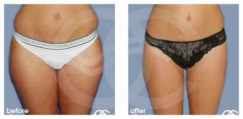 Fettabsaugung 02 LIPOSUKTION LOVE HANDELS UND REITERHOSEN before after forntal