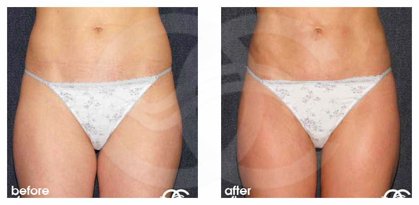 Fettabsaugung 03 LIPOSUKTION HÜFTEN UND REITERHOSEN before after forntal