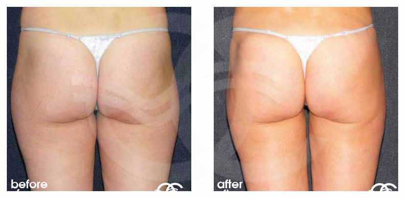 Fettabsaugung 03 LIPOSUKTION HÜFTEN UND REITERHOSEN before after perfil