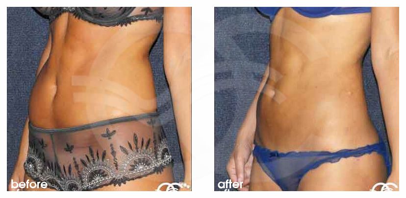Liposuction LOVE HANDLES ante/post-op lateral