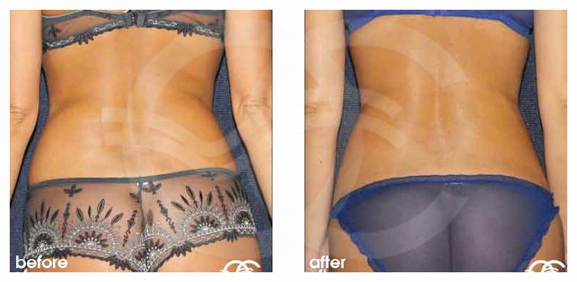 Fettabsaugung 04 LIPOSUKTION 'LIEBESGRIFFE' UND GÜRTELLINIE before after perfil