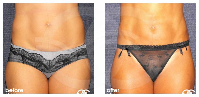Liposuction FLANKS AND STOMACH AREA ante/post-op profil