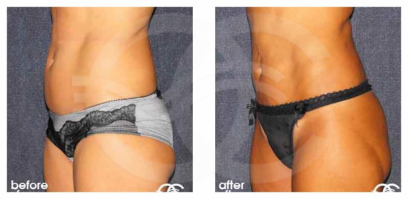 Liposuction FLANKS AND STOMACH AREA ante/post-op lateral