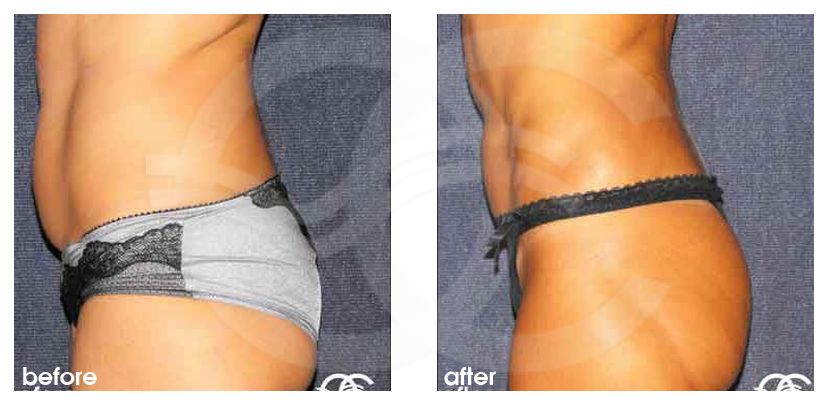Liposuction FLANKS AND STOMACH AREA ante/post-op retro/lateral