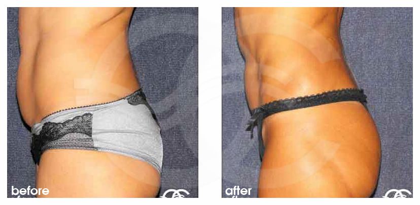 Fettabsaugung 05 LIPOSUKTION BAUCHBEREICH UND TAILLE before after perfil