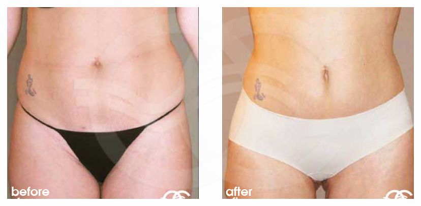 Fettabsaugung 07 LIPOSUKTION BAUCH, TAILLE UND BEINE before after forntal