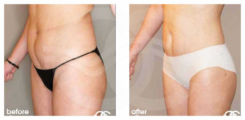 Fettabsaugung 07 LIPOSUKTION BAUCH, TAILLE UND BEINE before after side