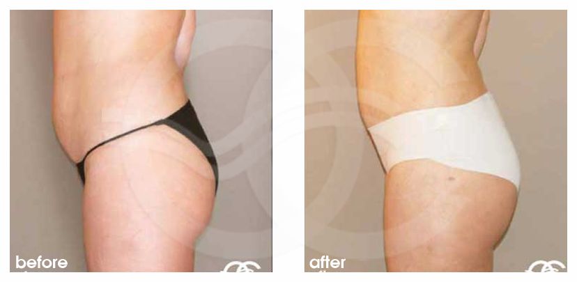 Fettabsaugung 07 LIPOSUKTION BAUCH, TAILLE UND BEINE before after perfil