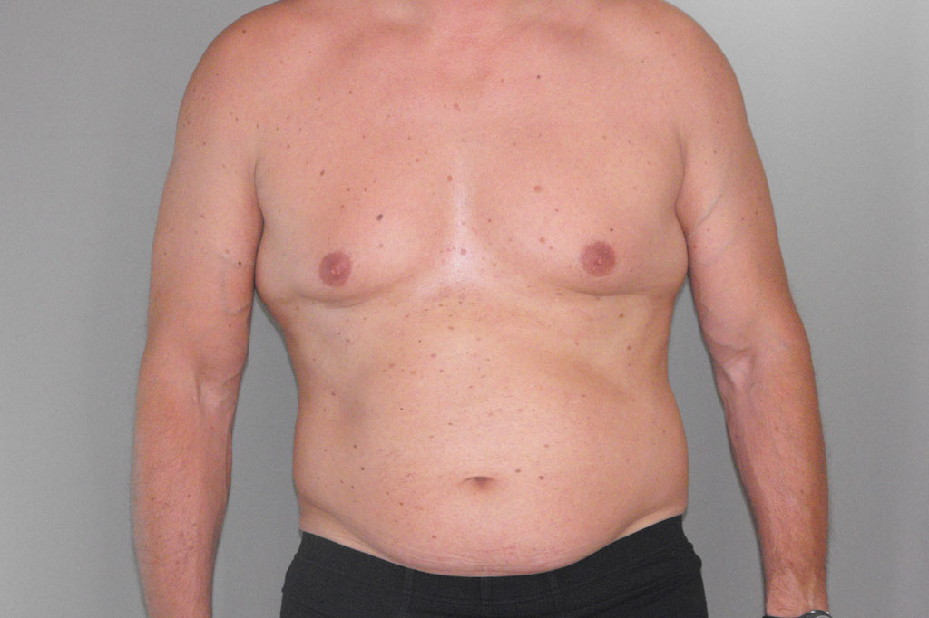 Gynecomastia MALE CHEST CONTOURING ante/post-op I