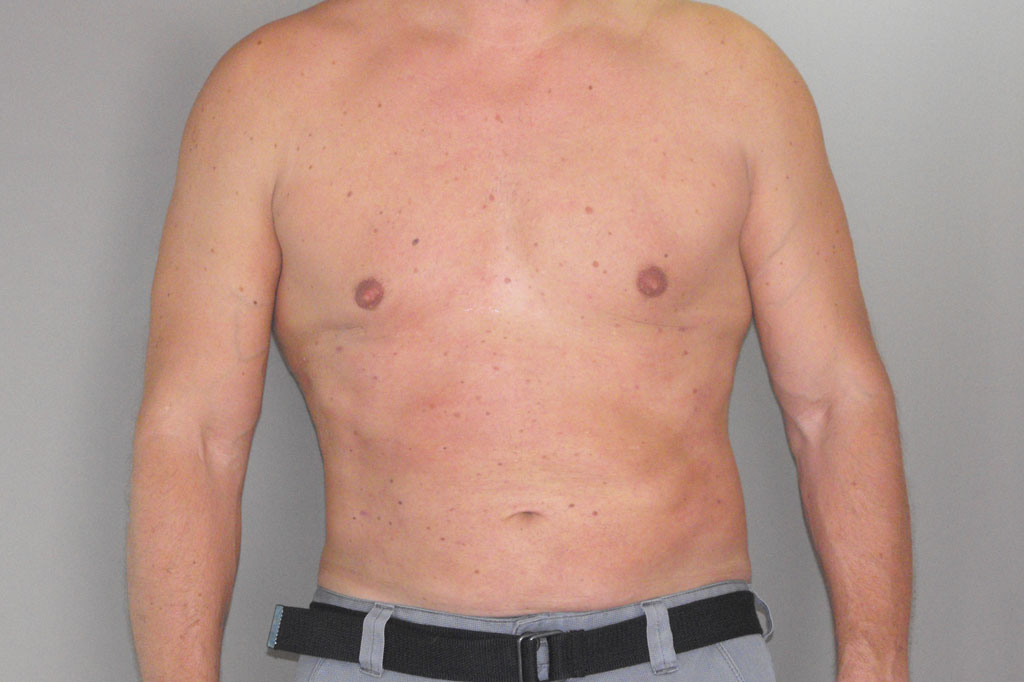 Gynecomastia MALE CHEST CONTOURING ante/post-op I