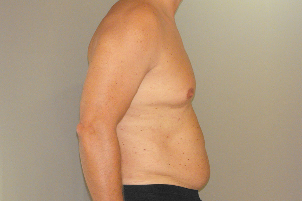 Gynecomastia MALE CHEST CONTOURING ante/post-op II