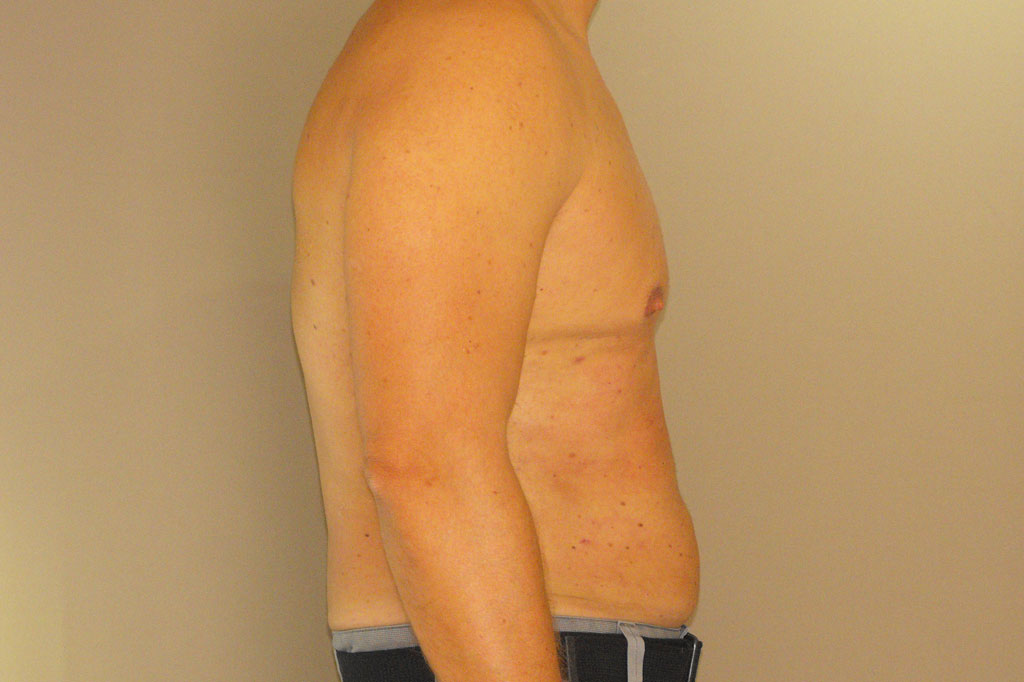 Photos Gynecomastia  ante/post-op II