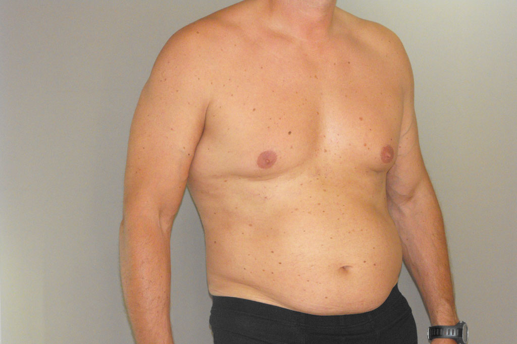 Gynecomastia MALE CHEST CONTOURING ante/post-op III