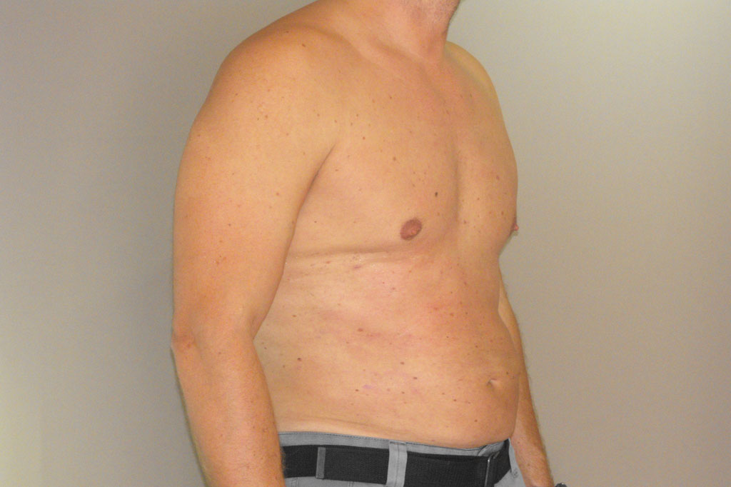 Gynecomastia MALE CHEST CONTOURING ante/post-op III