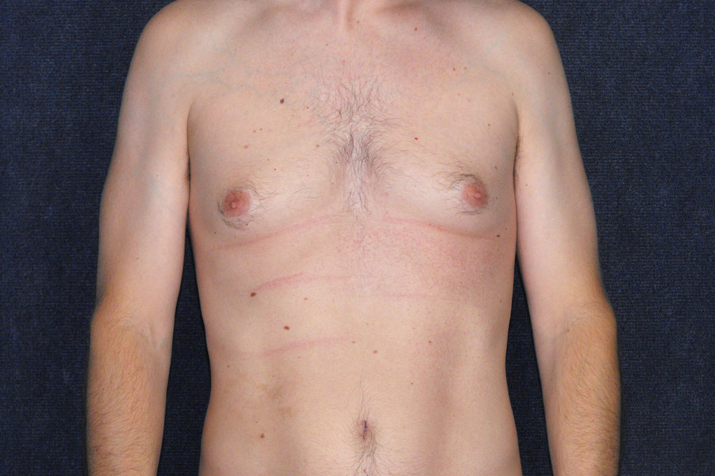 Gynecomastia with liposuction ante-op profil