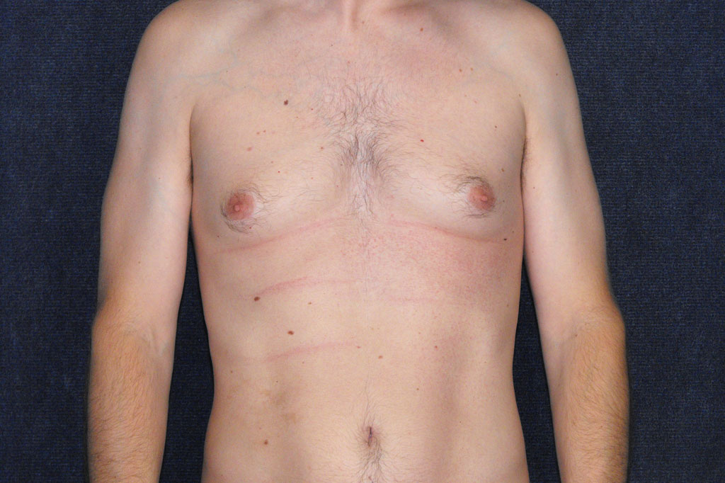 Gynecomastia with liposuction ante/post-op I