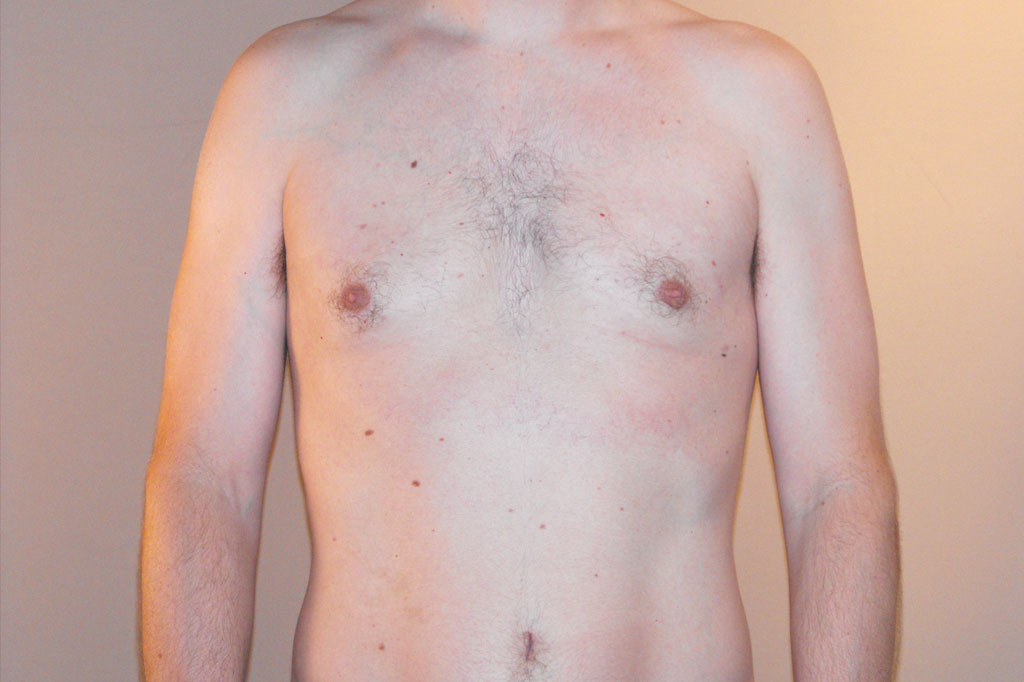 Gynecomastia with liposuction ante/post-op I