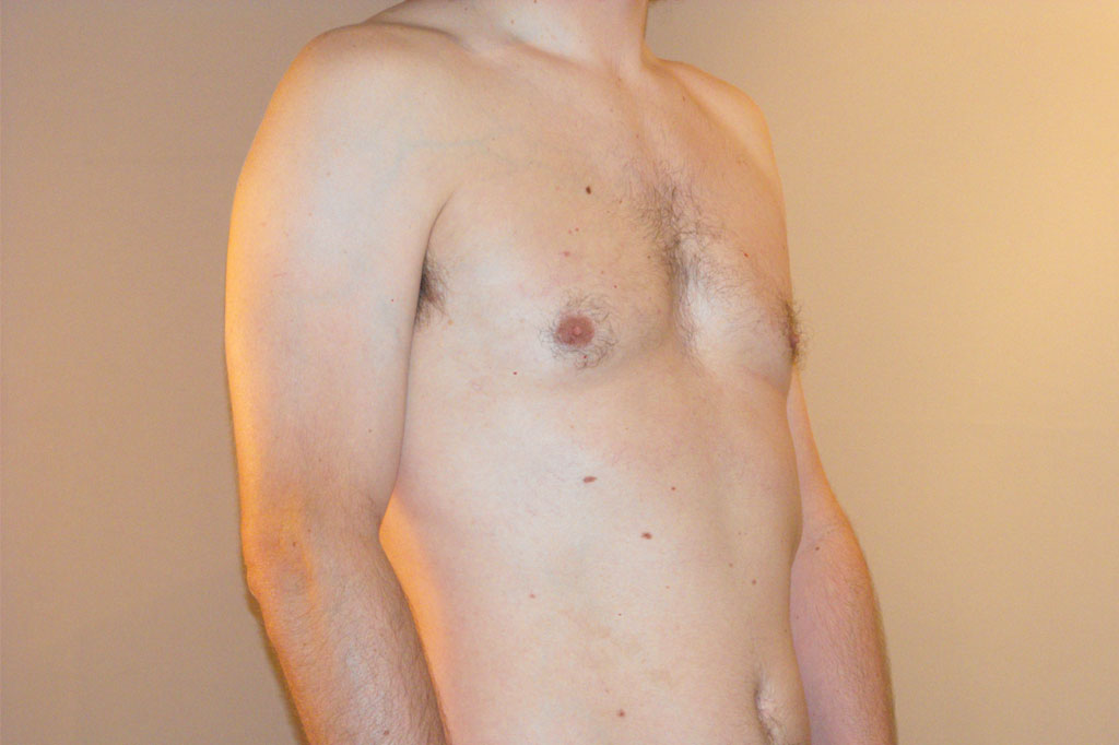 Gynecomastia with liposuction ante/post-op II