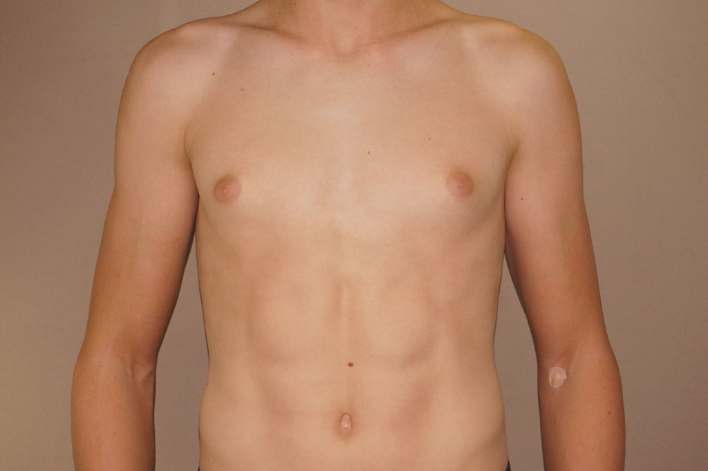 Gynecomastia with partial gland removal ante/post-op I