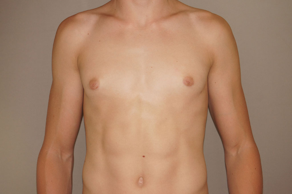 Gynecomastia with partial gland removal ante/post-op I