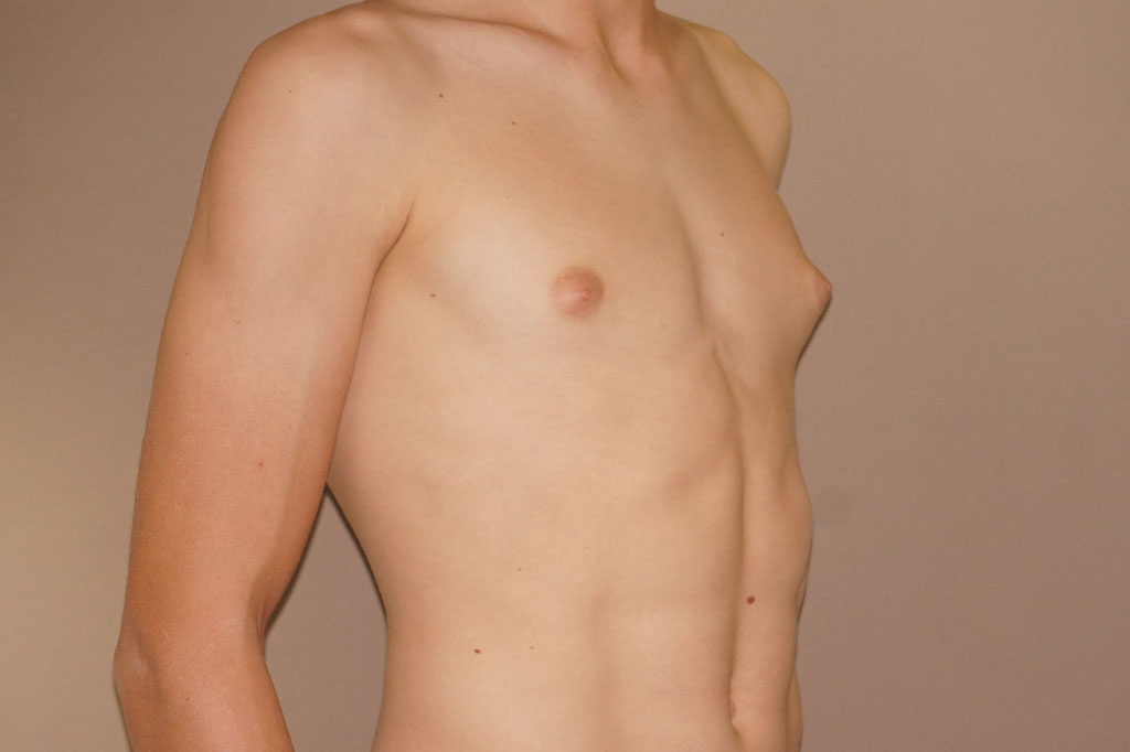 Gynecomastia with partial gland removal ante-op lateral