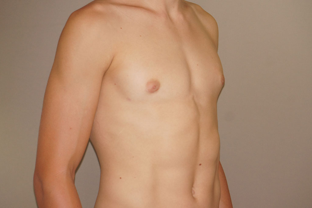 Gynecomastia with partial gland removal ante/post-op II