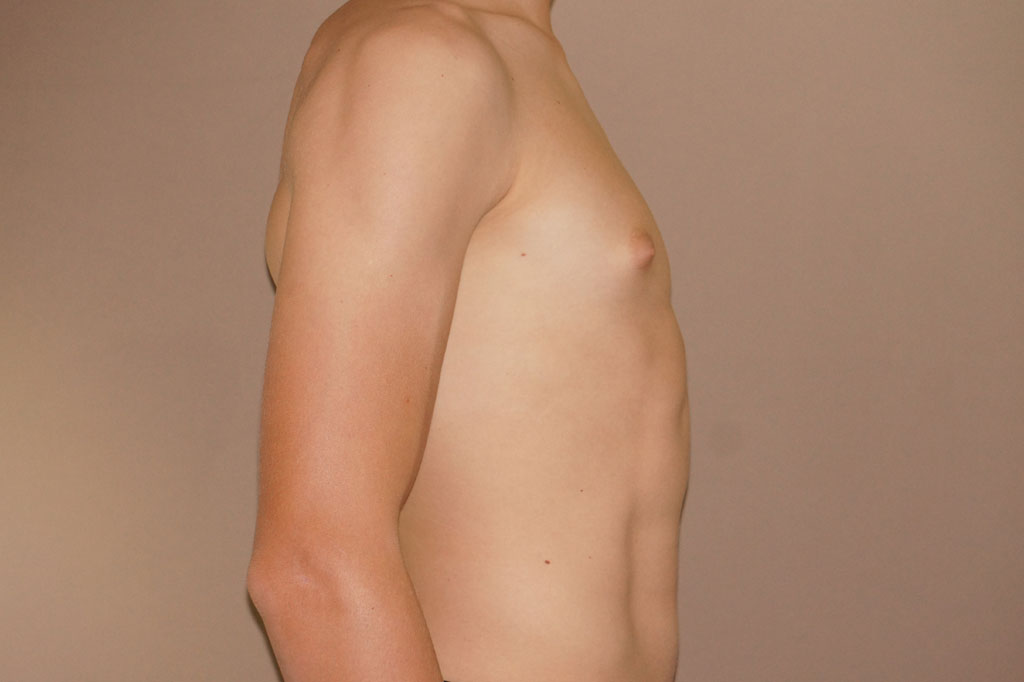 Gynecomastia with partial gland removal ante/post-op III