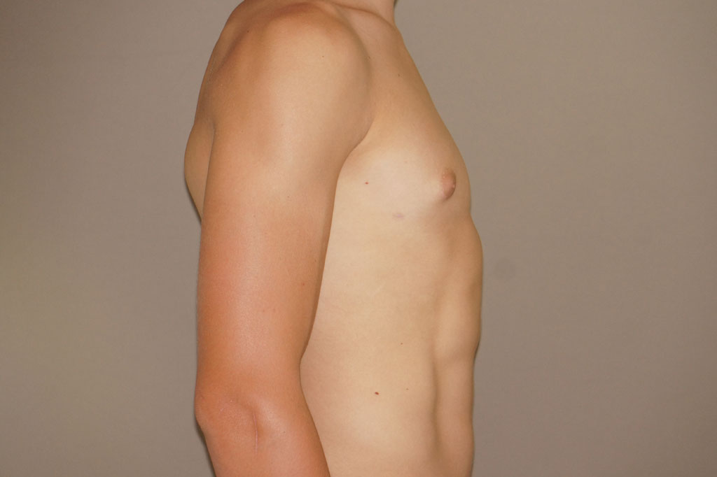 Gynecomastia with partial gland removal ante/post-op III