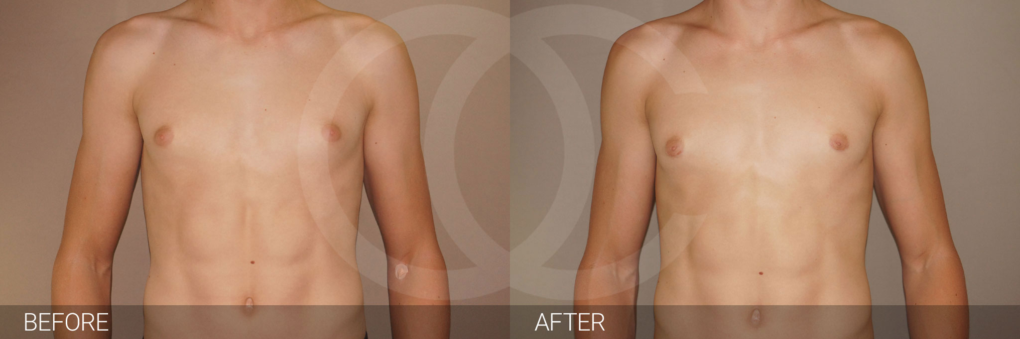 Gynecomastia with partial gland removal ante/post-op I