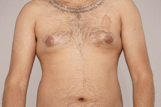 Gynecomastia MALE BREAST (GLAND) REDUCTION ante/post-op I