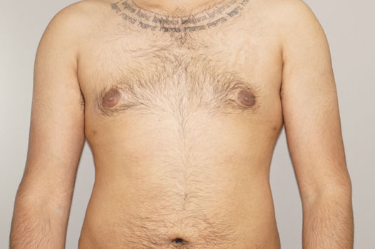 Gynecomastia MALE BREAST (GLAND) REDUCTION ante/post-op I