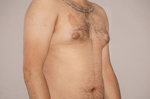 Gynecomastia MALE BREAST (GLAND) REDUCTION ante/post-op II