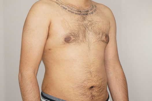 Gynecomastia MALE BREAST (GLAND) REDUCTION ante/post-op II