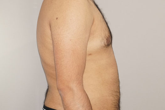 Photos Gynecomastia  ante/post-op III