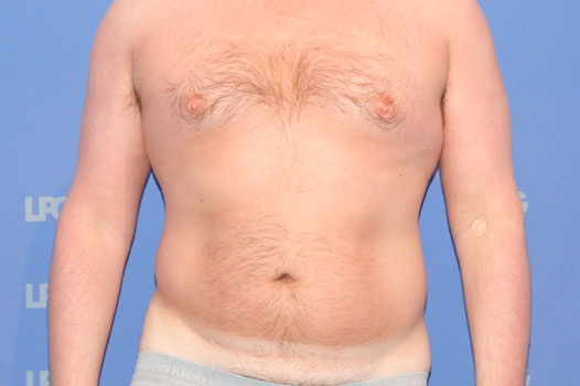 Gynecomastia CHEST, ABDOMEN AND LOVE HANDLES ante/post-op I