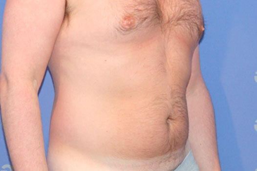 Gynecomastia CHEST, ABDOMEN AND LOVE HANDLES ante/post-op II