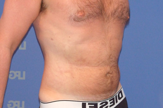 Gynecomastia CHEST, ABDOMEN AND LOVE HANDLES ante/post-op II