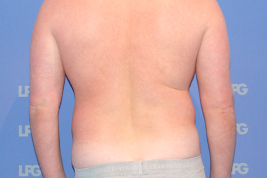 Photos Gynecomastia  ante/post-op III