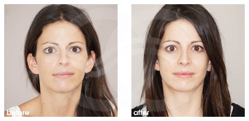 Nose Correction before and after real clinical case 01