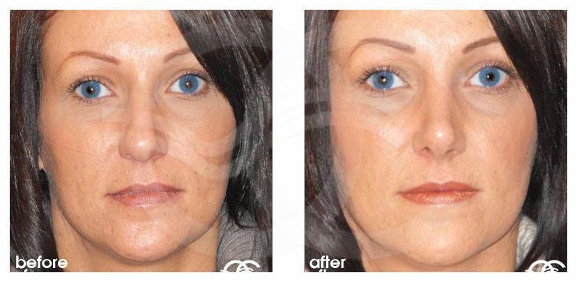 Nasenkorrektur 02 RHINOPLASTIK CHIRURGISCHE KORREKTUR DER NASE before after forntal