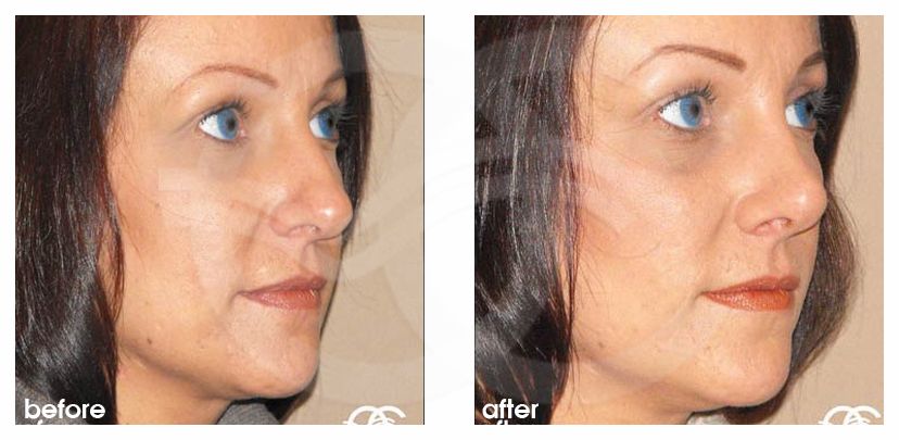 Nasenkorrektur 02 RHINOPLASTIK CHIRURGISCHE KORREKTUR DER NASE before after side