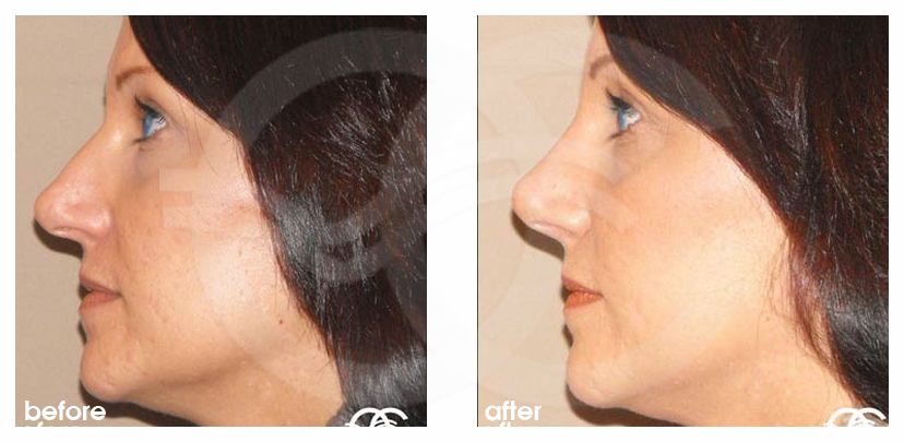 Nasenkorrektur 02 RHINOPLASTIK CHIRURGISCHE KORREKTUR DER NASE before after perfil