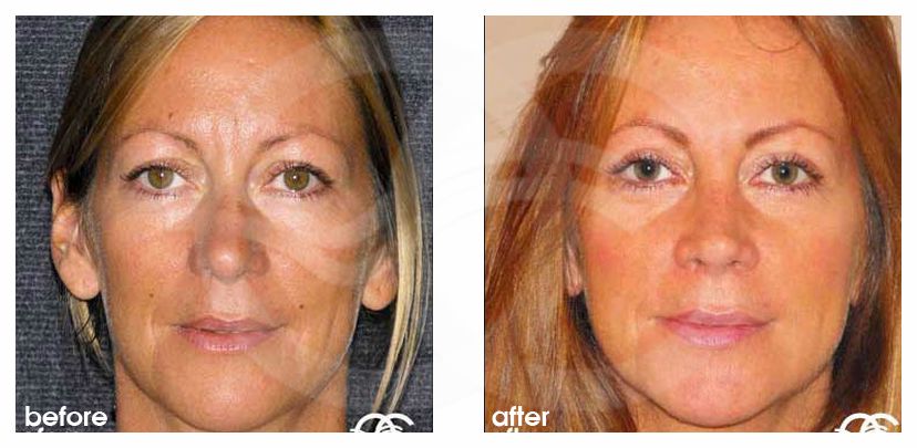 Nasenkorrektur 03 RHINOPLASTIK UMFORMMUNG DER NASE before after forntal