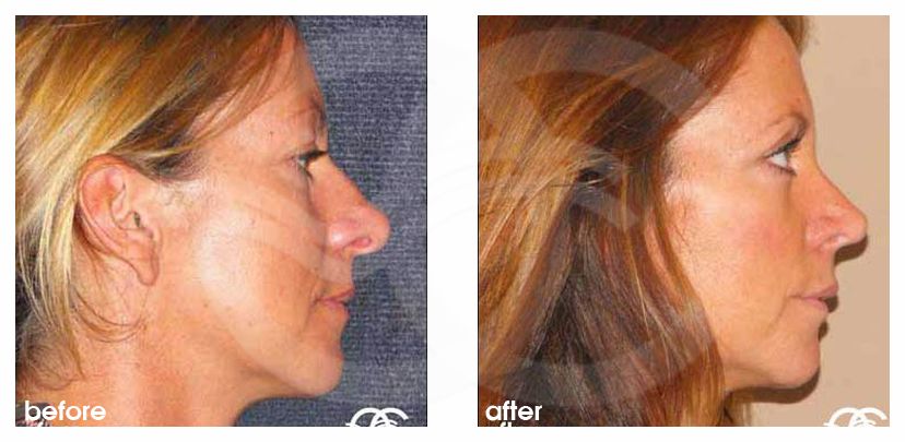 Nasenkorrektur 03 RHINOPLASTIK UMFORMMUNG DER NASE before after perfil