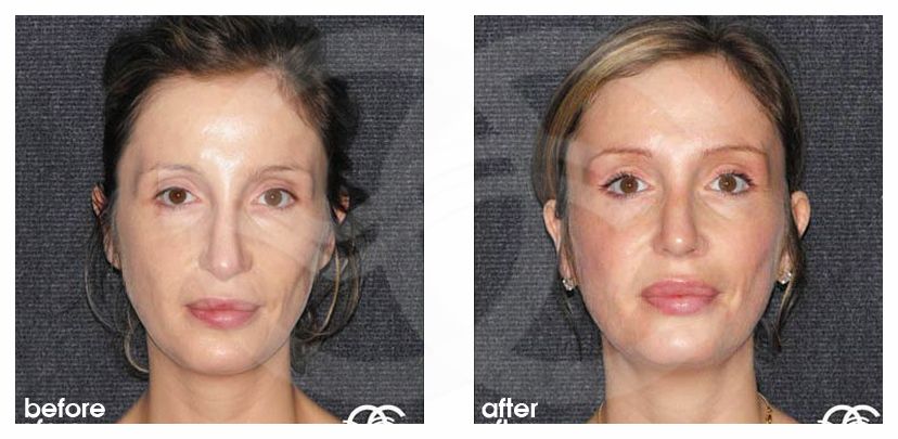 Nasenkorrektur 04 RHINOPLASTIK HARMONISCHES ERGEBNIS before after forntal