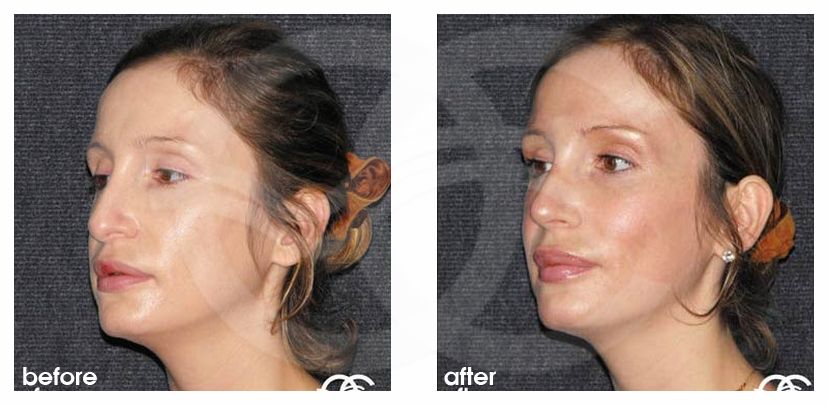 Nasenkorrektur 04 RHINOPLASTIK HARMONISCHES ERGEBNIS before after side