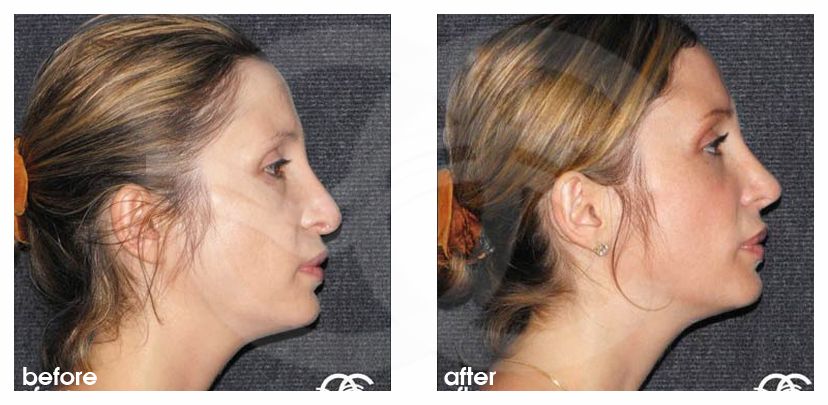 Nasenkorrektur 04 RHINOPLASTIK HARMONISCHES ERGEBNIS before after perfil