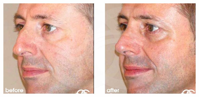 Nasenkorrektur 05 GESCHLOSSENE RHINOPLASTIK HÖCKERNASE before after forntal