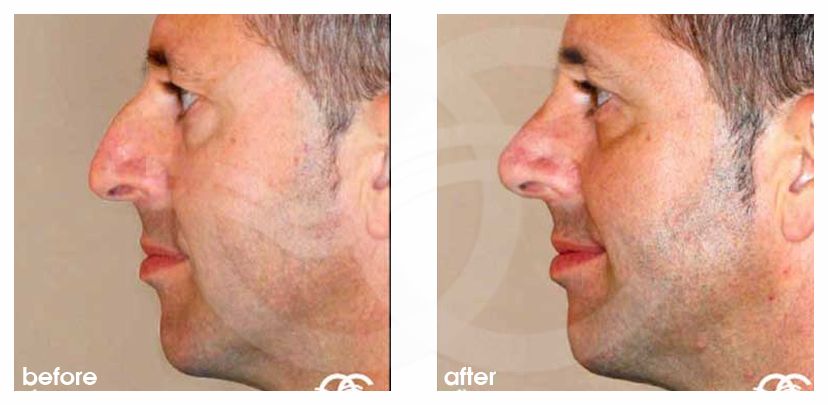 Nasenkorrektur 05 GESCHLOSSENE RHINOPLASTIK HÖCKERNASE before after side